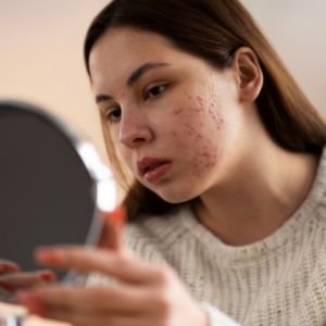 Best Skincare for Acne