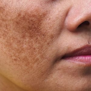 Skincare for Dark Spots