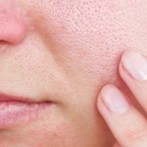 large-pores-treatment-bangladesh