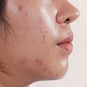 Best Skincare for Oily Skin in Bangladesh – Glow Up Skin Care BD
